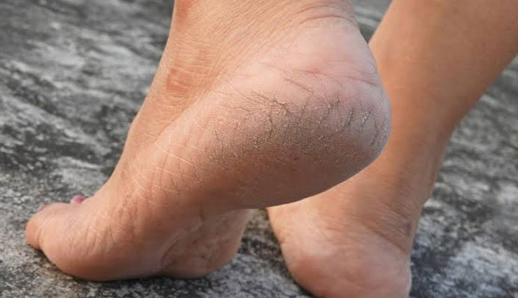 natural ways to treat cracked heels,home remedies,home remedies to treat cracked heels,cracked heels tips,beauty tips,heels care tips,skin care tips