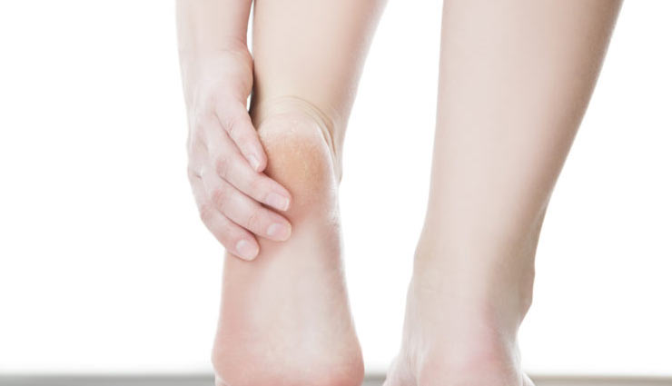 cracked heels,remedies for cracked heels,heels care tips,beauty tips,legs care tips,skin care tips