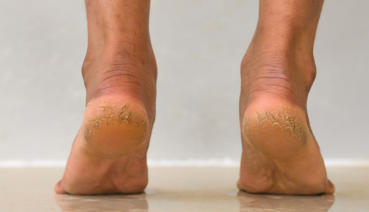 3 Ayurvedic Remedies Effective To Treat Cracked Heels