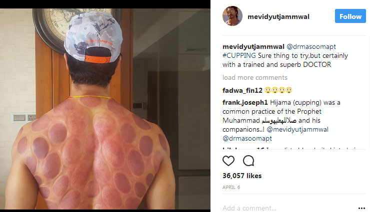 vidyut jammwal is going through hell pain,vidyut jammwal,cupping therapy