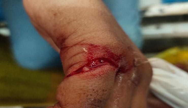 सीकर : मांझे की चपेट में आने से जख्मी हुए बच्चे, कई पतंग लूटने के चक्कर में छतों से कूदे