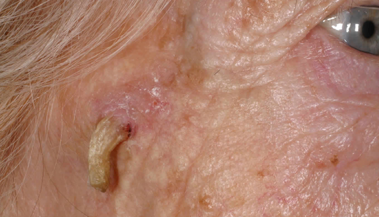 skin cancer symptoms,skin cancer types,skin cancer on face,skin cancer treatment,skin cancer on nose,skin cancer black skin,skin cancer by race,vitamin b skin cancer benefits,skin cancer color,skin cancer center,skin cancer cream,skin cancer color ribbon,vitamin c skin cancer treatment,vitamin c skin cancer prevention,skin cancer diagnosis,skin cancer detection,vitamin d skin cancer,vitamin d skin cancer treatment