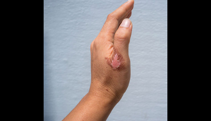 cuts and burn marks,home remedies,beauty tips,skin care tips