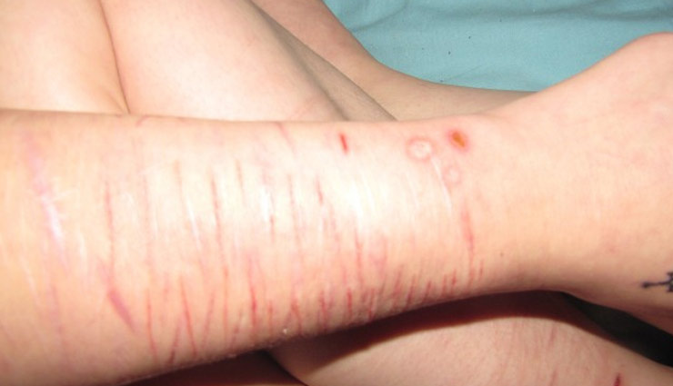 आपकी ख़ूबसूरती में कमी लाते है जलने-कटने के निशान, इस समस्या को दूर करने के लिए आजमाए ये घरेलू उपाय 