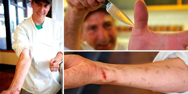 cuts and burn marks,home remedies,beauty tips,skin care tips