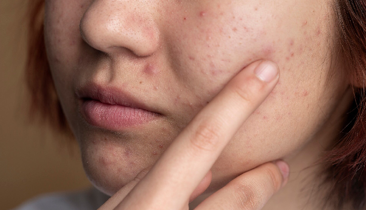 8 DIY Ways to Treat Damaged Skin in Winters