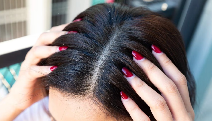 6 DIY Ways To Use Fenugreek Seeds To Treat Dandruff