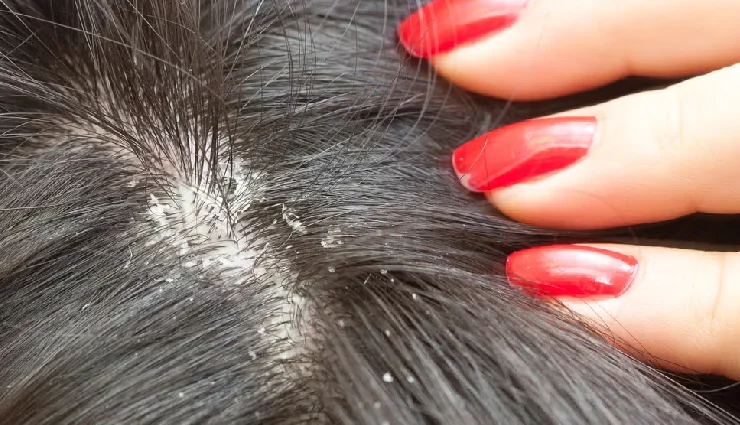 7 Effective Home Remedies To Treat Dandruff