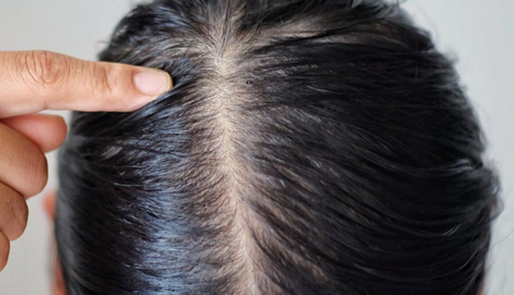 dandruff,causes of dandruff,hair care tips,beauty tips