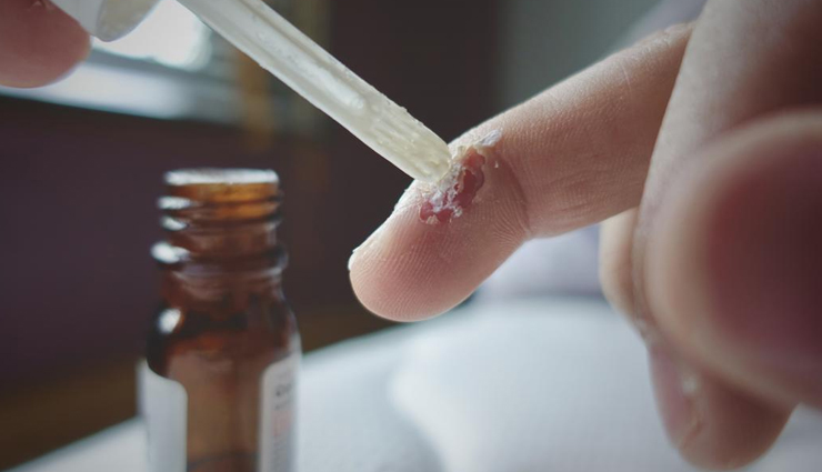 dandruff,ways to get rid of dandruff,hair care tips,beauty tips