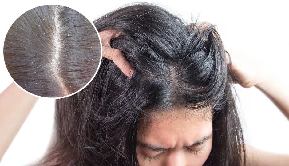 सर्दियों में  बढ़ जाती है डैंड्रफ की परेशानी, नहाते समय इन 10 गलतियों से बचें