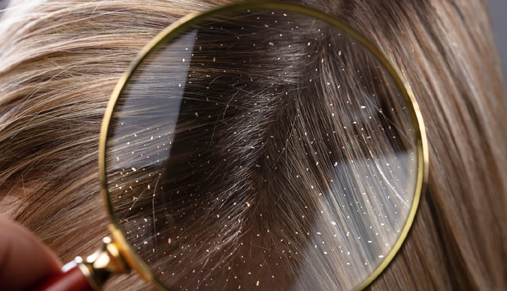 5 Home Remedies To Treat Dandruff