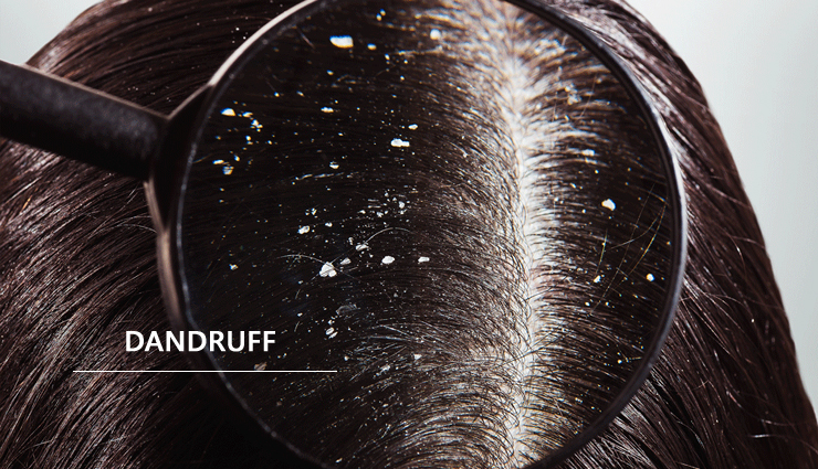 girl faces,hair problem,hair problem every girl face,hair loss,hair treatment,hair care tips,hair care,hair loss,beauty,beauty tips