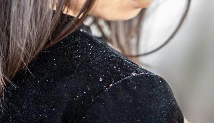 डैंड्रफ से आजादी दिलाएंगे घर पर बने ये पेस्ट, आजमाते ही दिखेगा असर