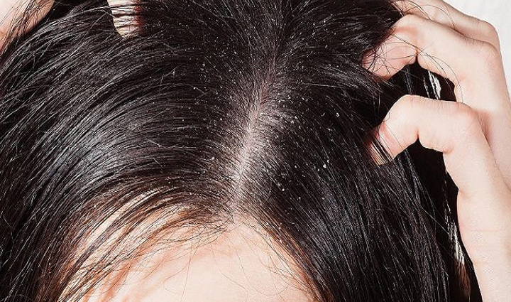 home remedies for dandruff,home remedies for dandruff in hair,causes of dandruff,causes of dandruff in winter,ways to get rid of dandruff,reasons of dandruff,beauty
