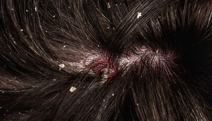 neem oil for hair growth,neem oil for dandruff treatment,benefits of neem oil for hair,neem oil for scalp health,neem oil for hair loss prevention,neem oil for hair conditioning,neem oil for treating scalp infections,neem oil for hair strengthening,neem oil for promoting hair thickness,neem oil for natural hair care