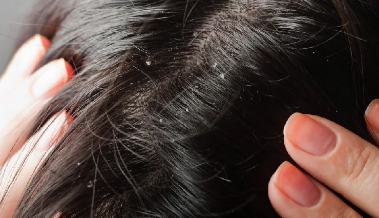 lemon for skin,lemon benefits,lemon face pack,lemon for acne,lemon for hair,natural skin remedies,lemon exfoliator,lemon toner,lemon for dandruff,glowing skin with lemon