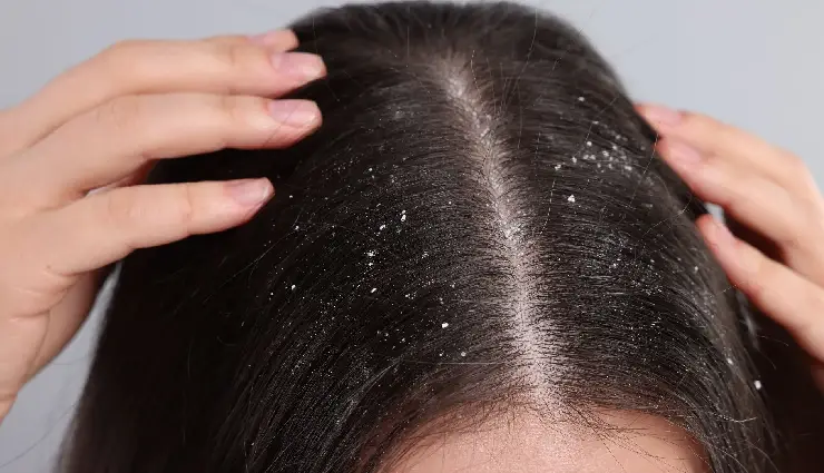 mint leaves benefits,pudina for skin,pudina for hair,mint for acne,natural dandruff remedy,mint cooling effect,herbal skincare tips,natural hair growth remedies,diy mint face pack,chemical-free beauty care