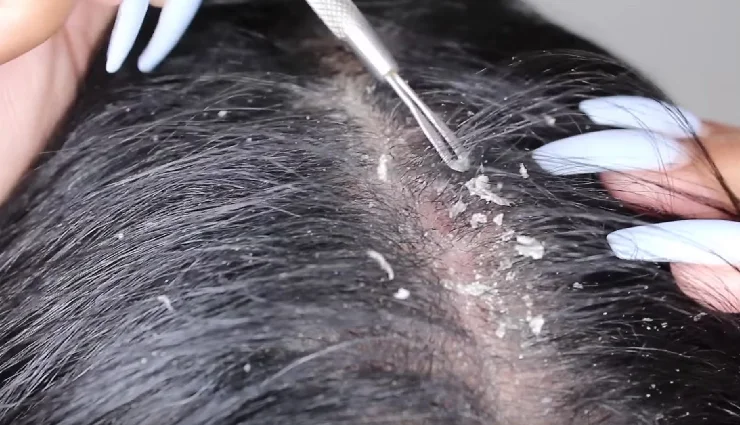 coconut water for skin,coconut water for hair,coconut water beauty benefits,coconut water for acne,coconut water for dandruff,coconut water glow,coconut water hydration,coconut water hair care,coconut water diy remedies,coconut water skincare tips