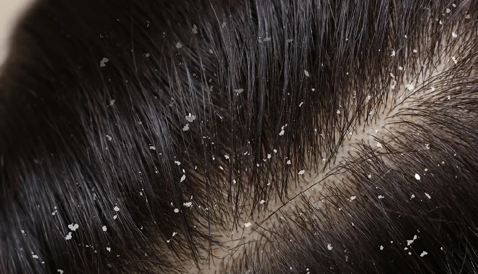 8 DIY Ways to Treat Dandruff in Winters