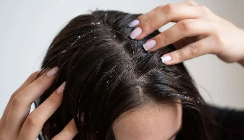 9 DIY Ways To Treat Dandruff in Winters