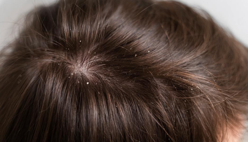7 Home Remedies To Fight Dandruff in Summers