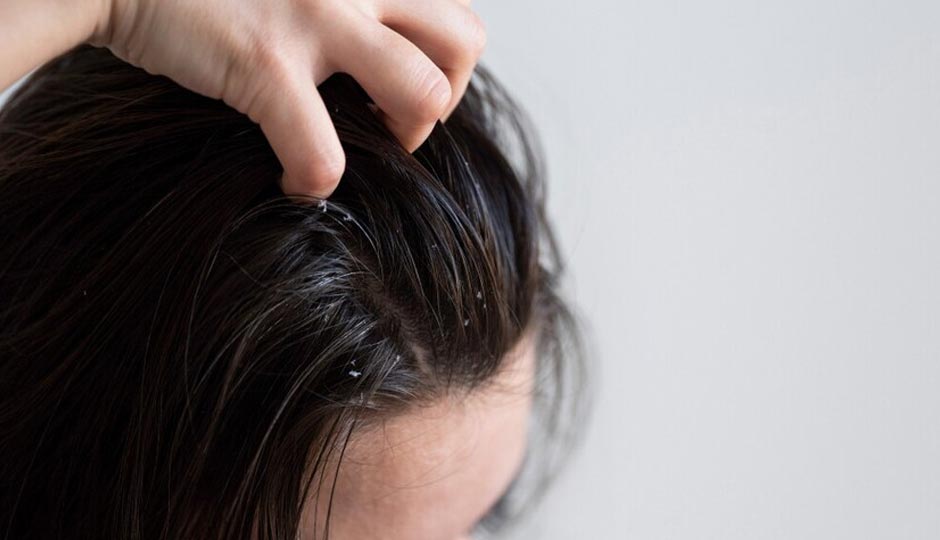 8 Home Remedies To Treat Dandruff in Summer