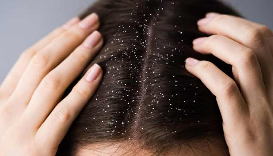 12 Home Remedies to Treat Dandruff in Changing Weather