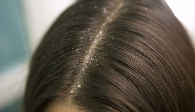 dandruff,major causes of dandruff,hair care tips,beauty tips