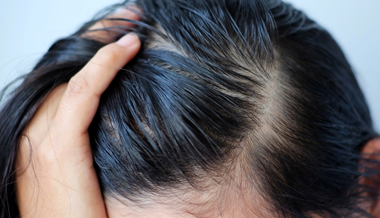 dandruff,causes of dandruff,hair care tips,beauty tips