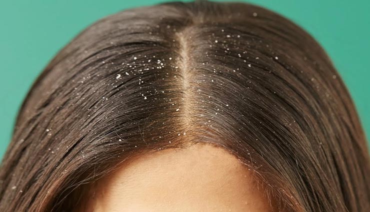 beauty tips,beauty tips in hindi,hair care tips,home remedies,remedies for dandruff,hair fall remedy