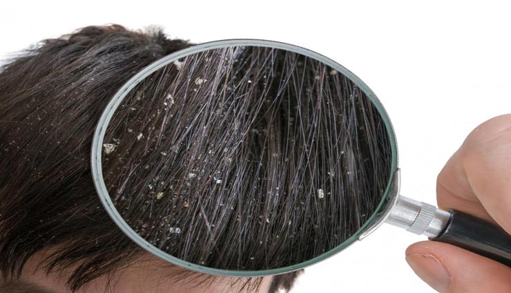 सर्दियों में पनपती हैं 'डैंड्रफ' की समस्या, इन नुस्खों से मिलेगी राहत