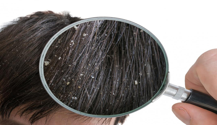 beauty tips,beauty tips in hindi,hair problems,home remedies,hair care tips