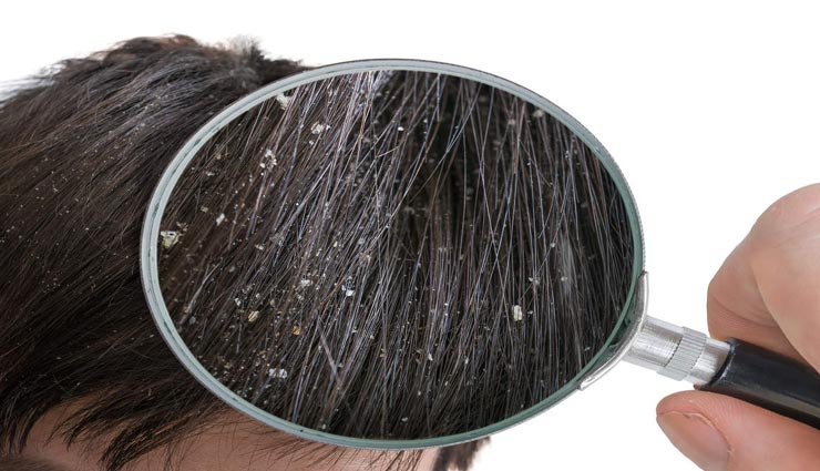 आपके जहन में उठे Dandruff से जुड़े हर सवाल का जवाब मिलेगा यहां 