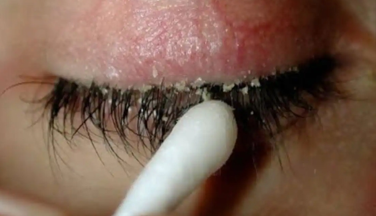 6 Home Remedies To Treat Dandruff on Eyelashes and Eyebrows