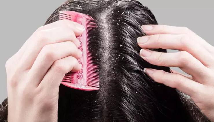 types of dandruff,dry scalp dandruff,oily scalp dandruff,fungal dandruff,psoriasis dandruff,seborrheic dermatitis,types of scalp conditions,dandruff causes,scalp health awareness,dandruff prevention tips