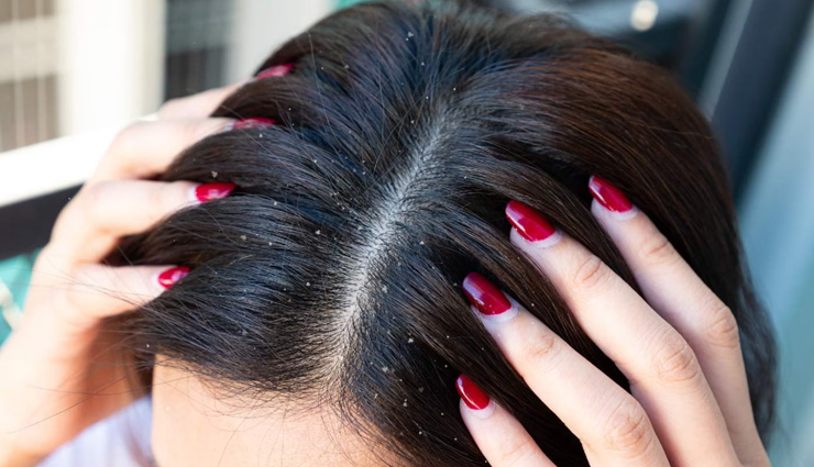 myths about dandruff,dandruff misconceptions,dandruff causes,how to treat dandruff,dandruff and hygiene,dandruff in men and women,dandruff and diet,seasonal dandruff,over-the-counter dandruff treatment,dandruff skin care tips