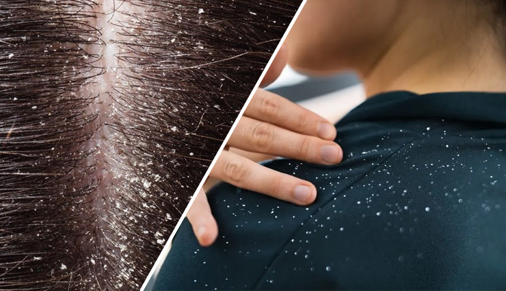 6 DIY Ways To Get Rid of Dandruff in Monsoon