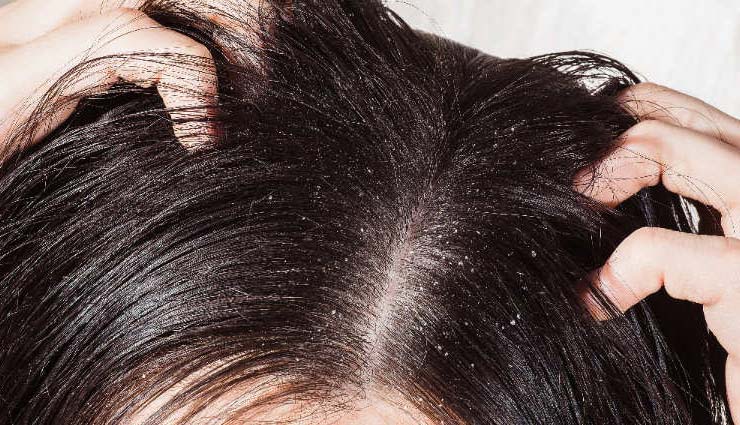 5 Effective Remedies To Treat Problem of Dandruff
