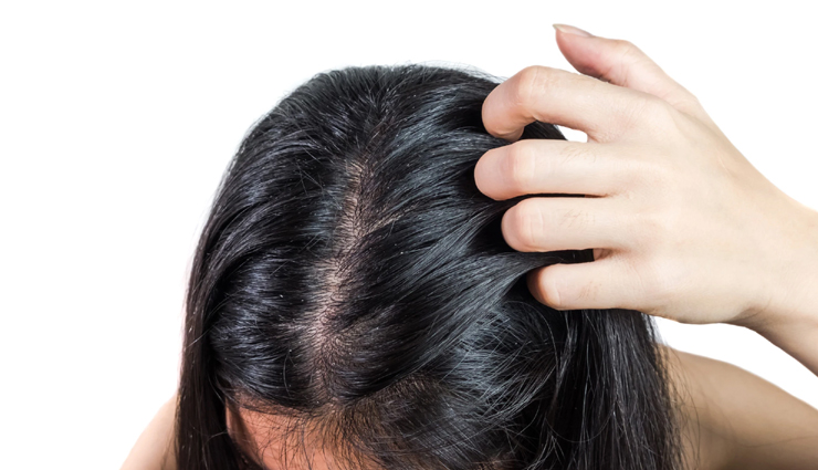 11 Simple and Effective Home Remedies To Treat Dandruff 