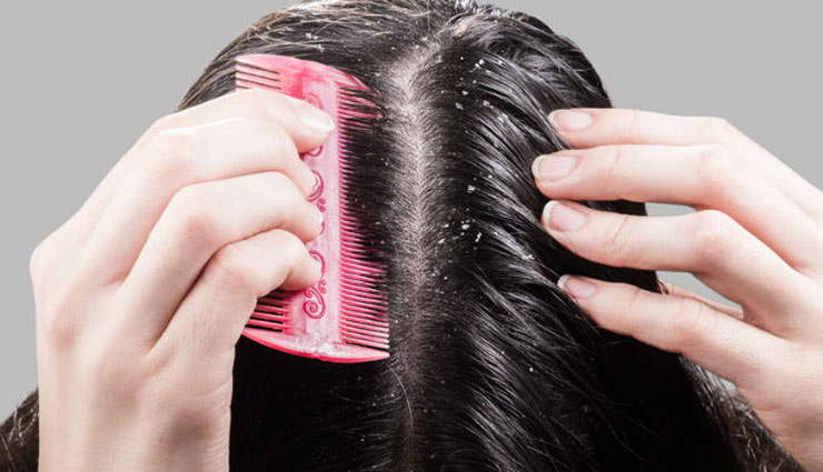 डैंड्रफ की वजह से आ रही है परेशानी, इन जादुई उपायों से छुडाएं पीछा