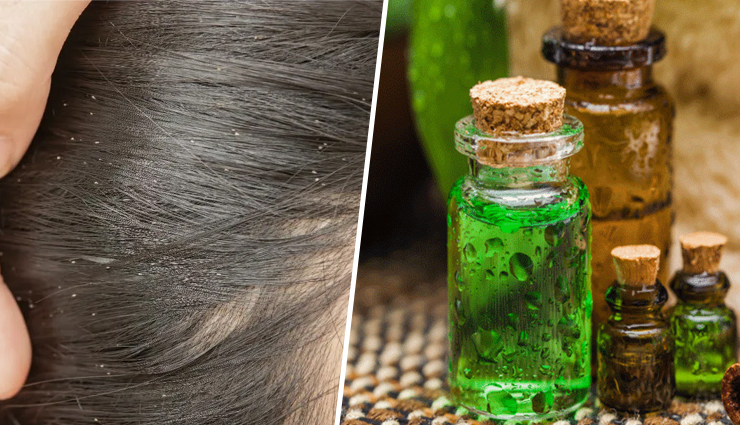 8 Homemade Tea Tree Oil Hair Masks for Common Dandruff Problems