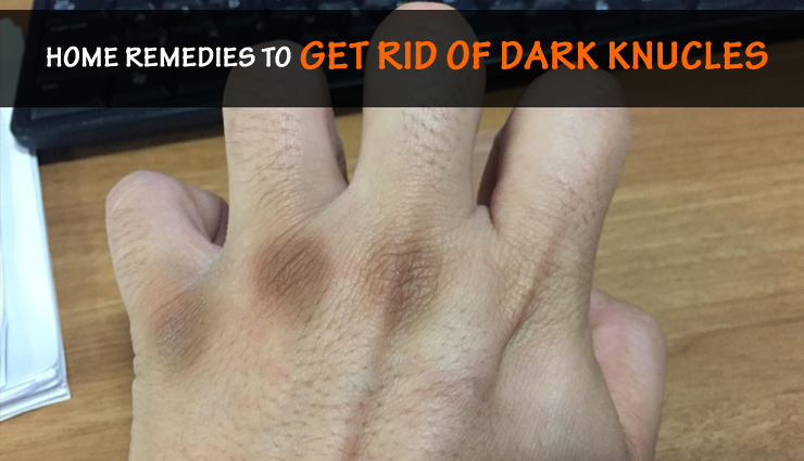 Get Rid of Dark Knucles With These 7 Home Remedies