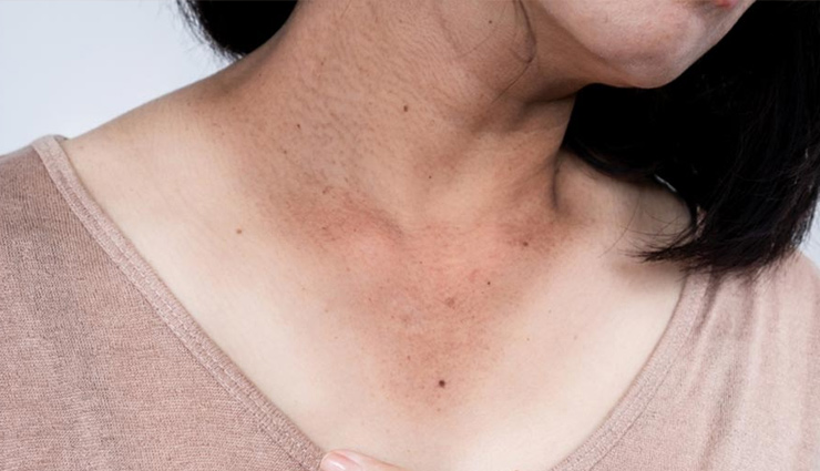 7 DIY Ways To Treat Dark Area Around Neck
