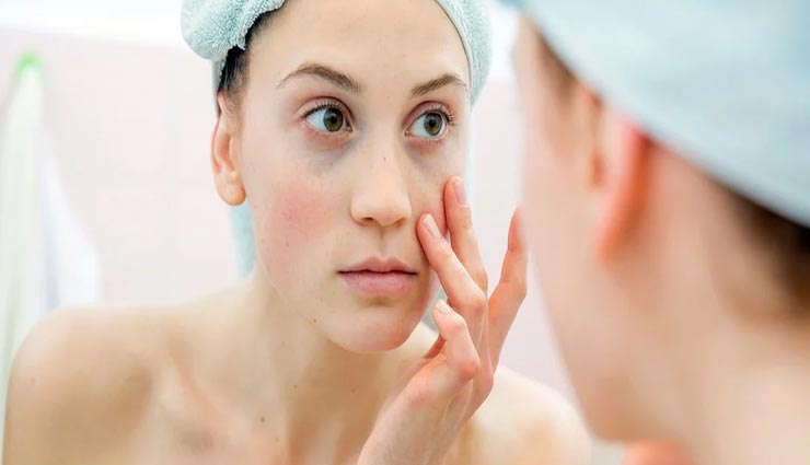 आंखों के नीचे काले घेरे घटाते हैं खूबसूरती, आजमाए ये असरदार नुस्खे