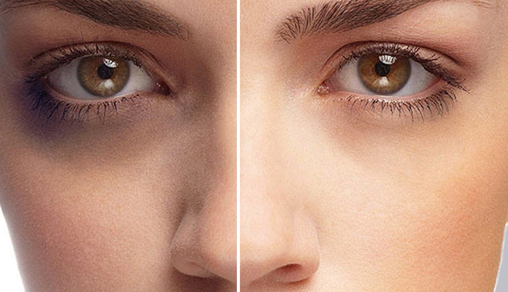 5 Ayurvedic Ways To Treat Dark Circles
