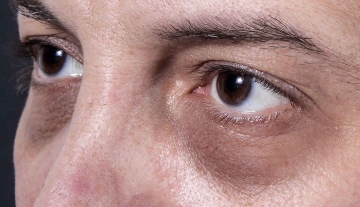 Home Remedies To Help You Treat Under Eye Dark Circles