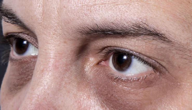 4 Tips To Deal With Dark Circles