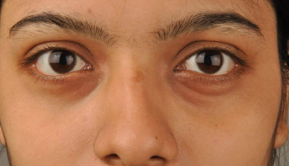 डार्क सर्कल्स हटाने के नेचुरल और असरदार घरेलू उपाय, बिना क्रीम के पाएं चमकती और फ्रेश आंखें