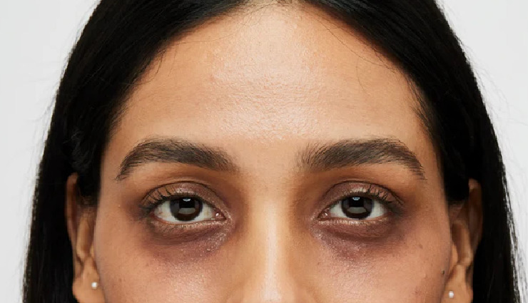 4 DIY Ways To Use Milk to Treat Dark Circles
